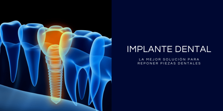 Implantes Dentales Madrid | WinDental