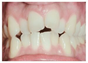 ortodoncia invisible antes