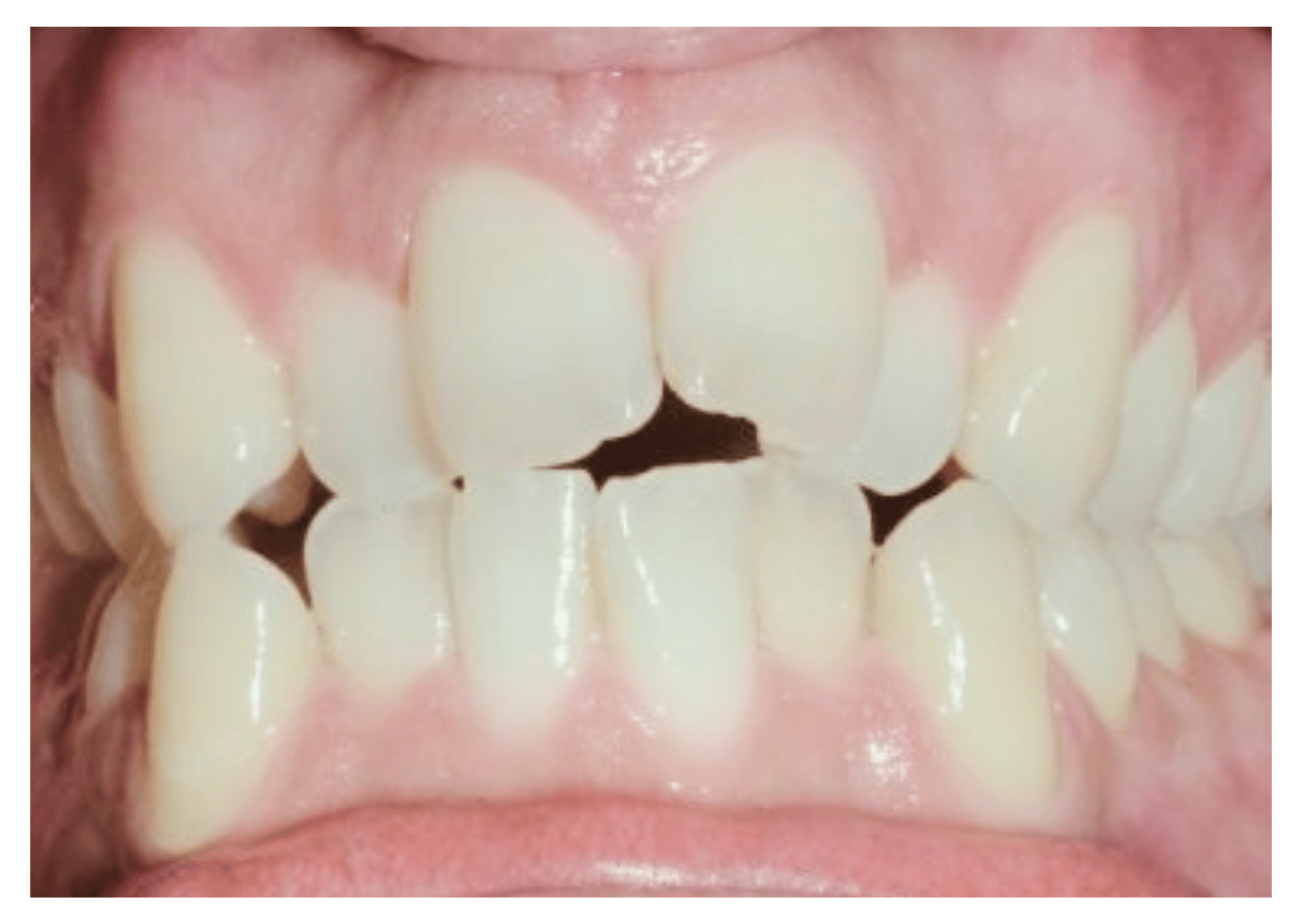 Ortodoncia invisible antes