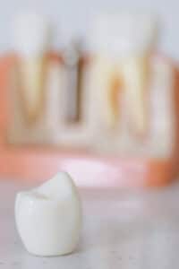 pérdida de soporte óseo dental